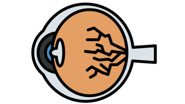 diabetic eye care in surat