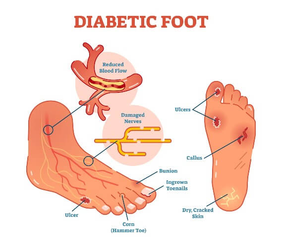 diabetic-foot-anatomical