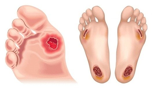 diabetic-foot-infection