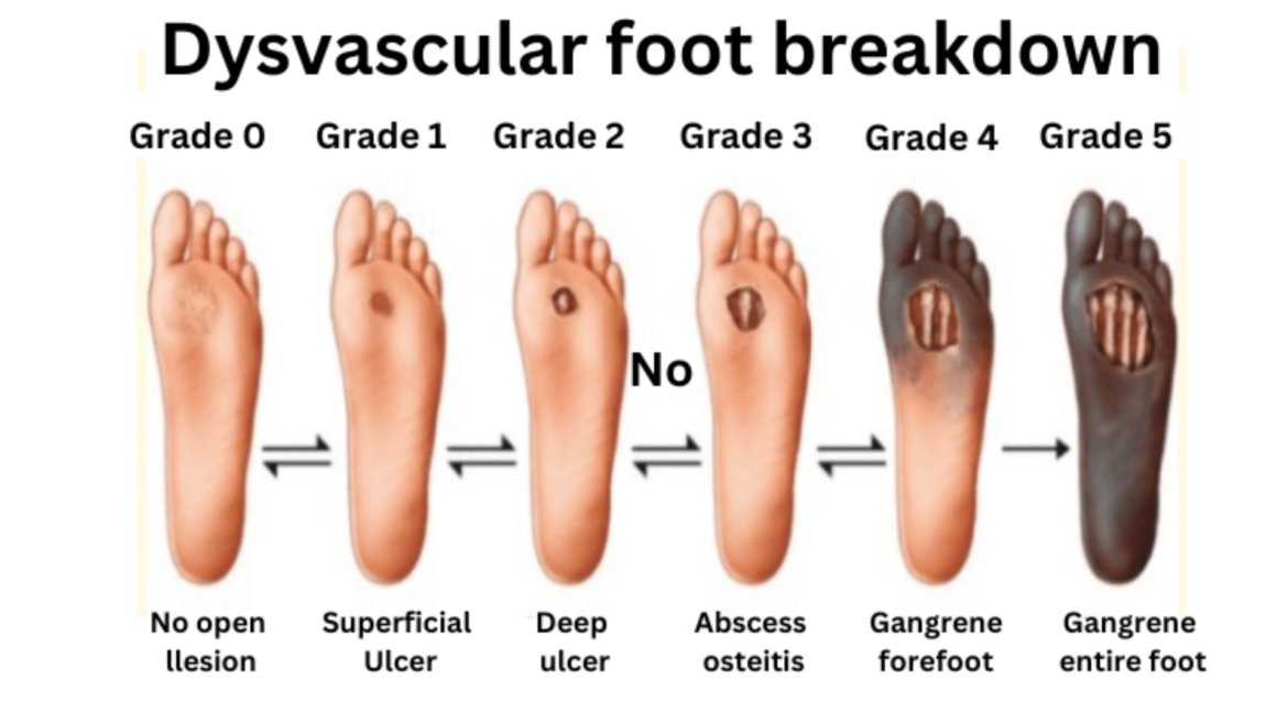 Diabetic foot care